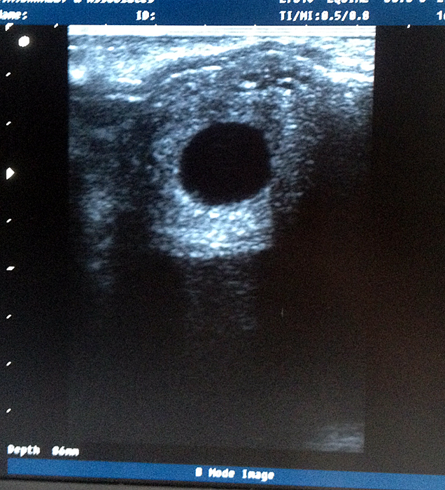 Frozen Semen Pregnancy 16 day conceptus